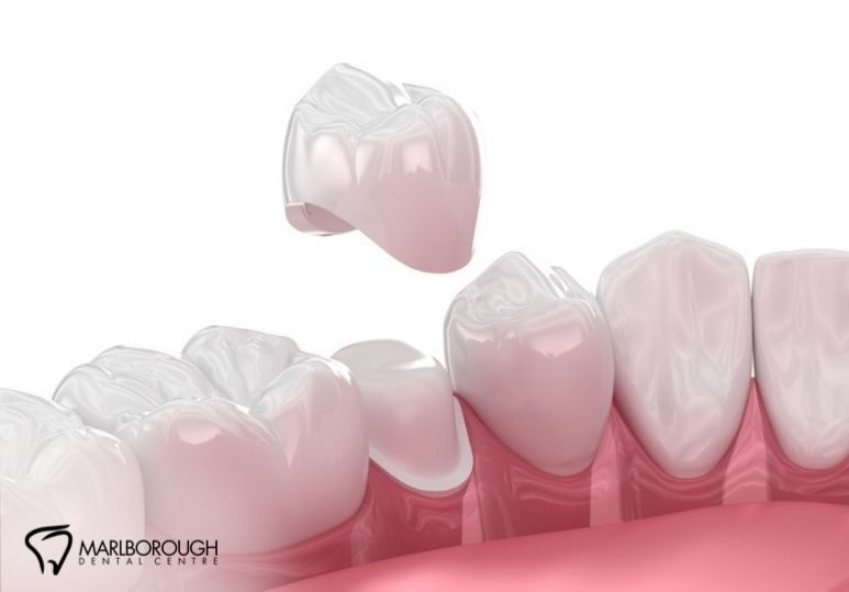 The Benefits of Dental Crowns: Why You Might Need One 